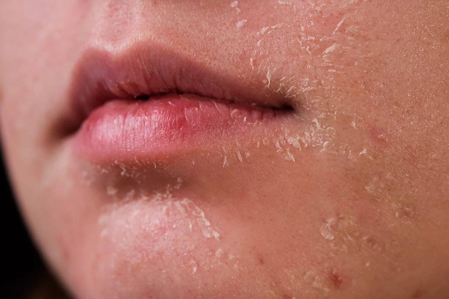 Dry Skin in Winter? Here’s Why It Happens and How to Treat It
